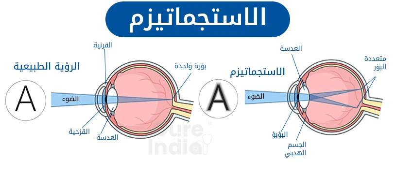 أنواع مختلفة من الاستجماتيزم